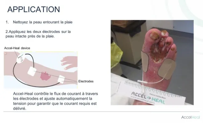 ACCEL HEAL, Saint-Paul, O2CM